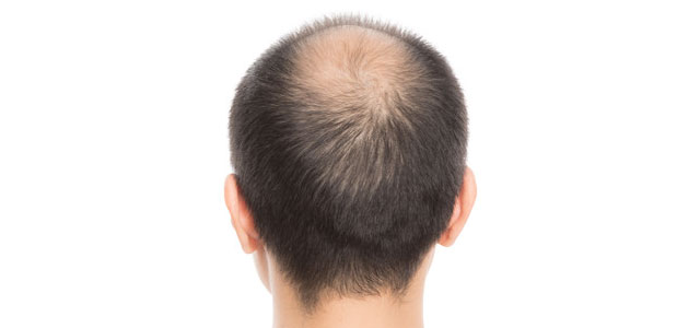 頭頂部の薄毛を治したい人 イメージ
